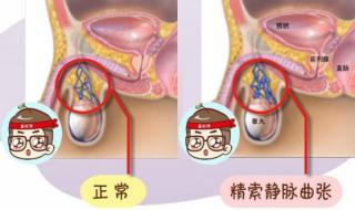 精索静脉曲张症状图 精索静脉曲张症状图